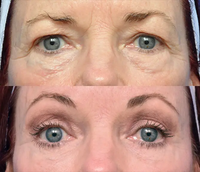 Facelift Journeys - Garcia Facial Plastic Surgery