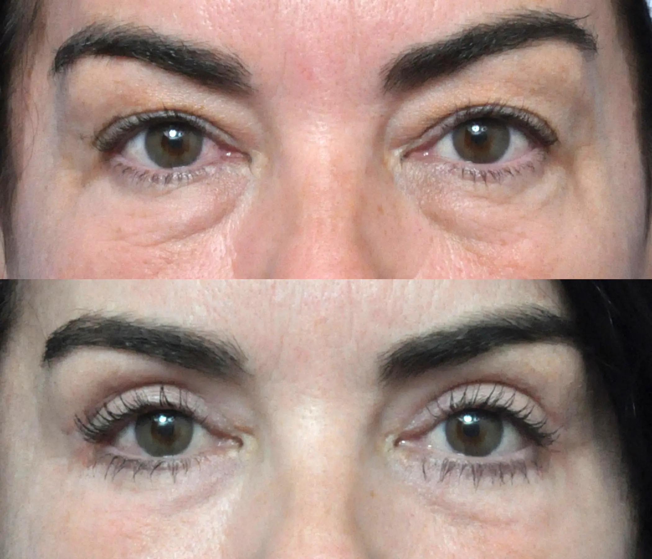 Eyelid Surgery in Jacksonville, FL