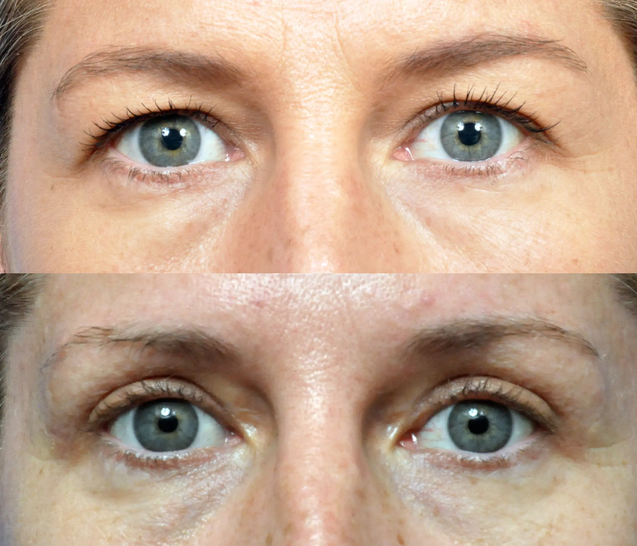Eyelid Surgery Journeys - Garcia Facial Plastic Surgery