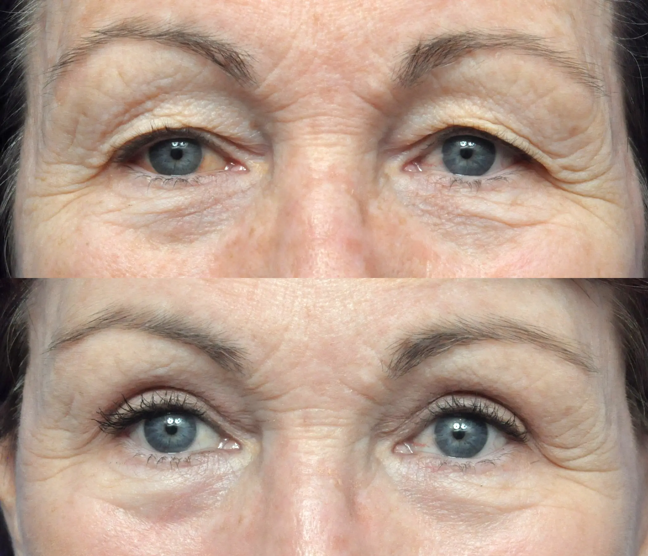 Facelift Journeys - Garcia Facial Plastic Surgery