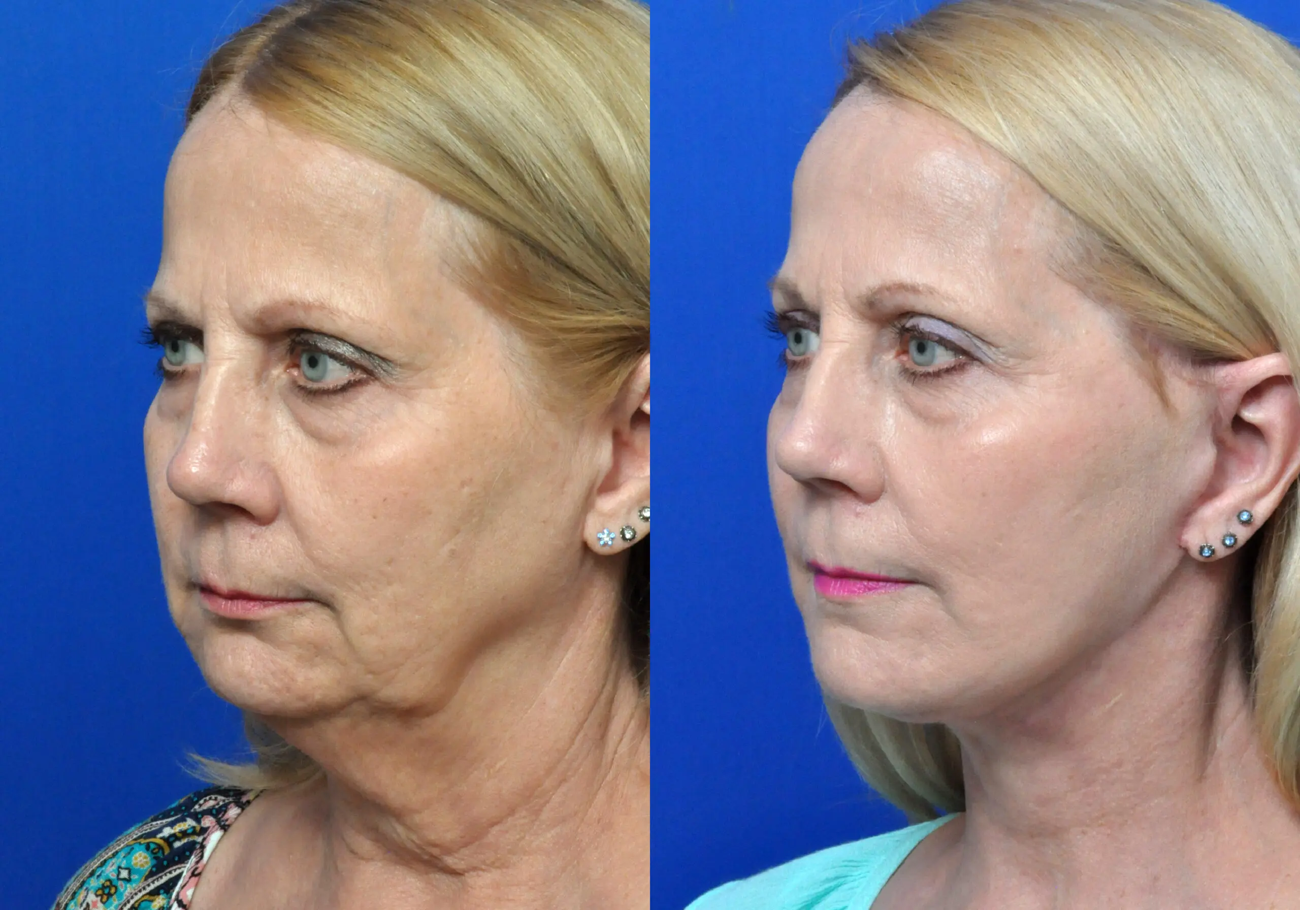 Neck Lift - Garcia Facial Plastic Surgery