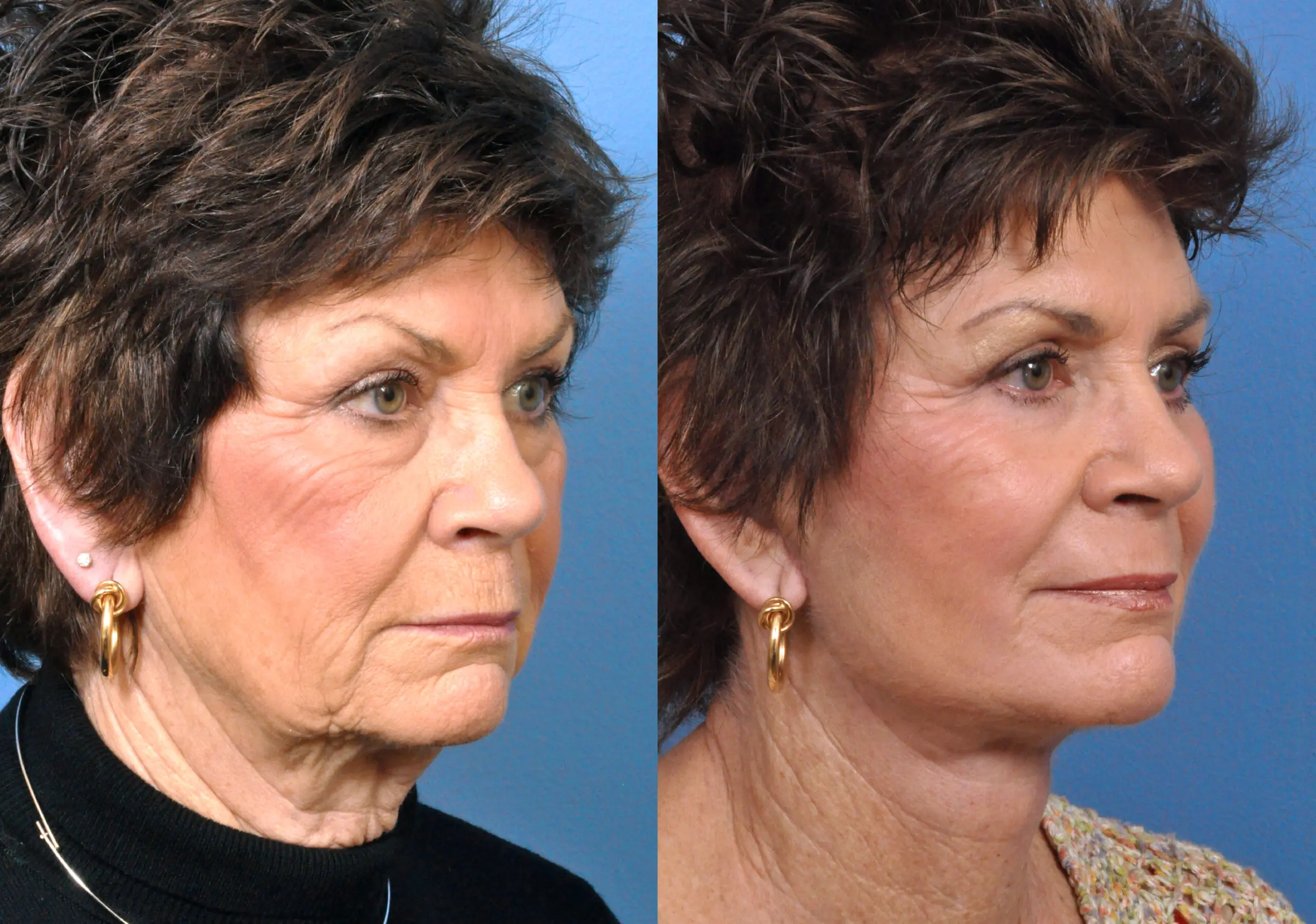 Neck Lift in Jacksonville, FL