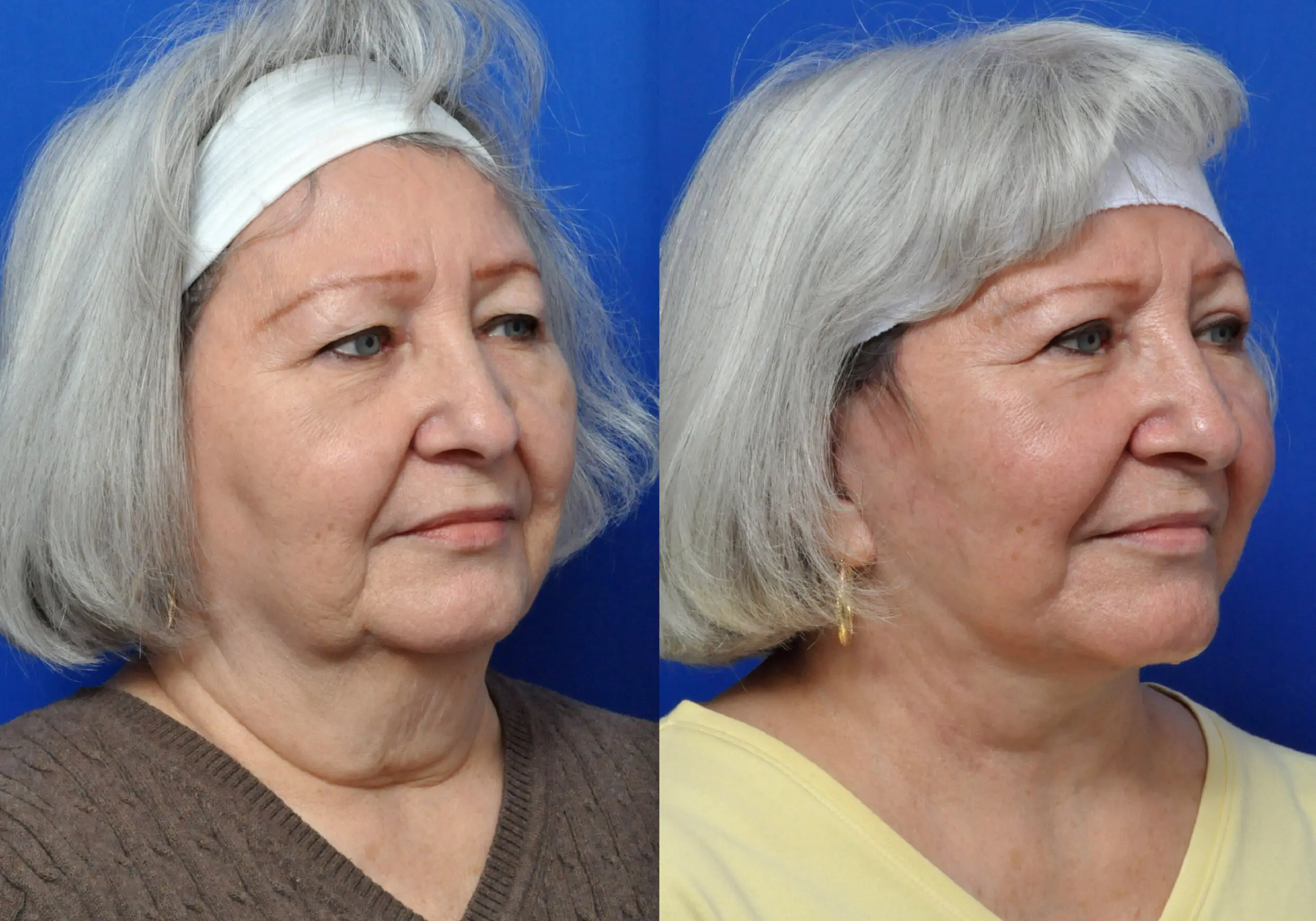Neck Lift in Jacksonville, FL