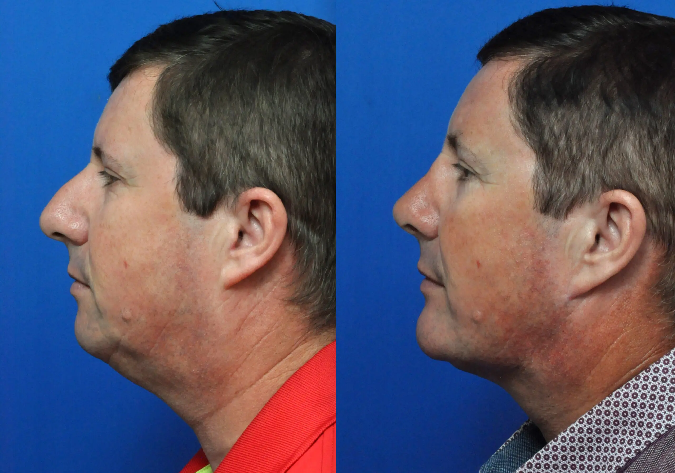 Facial Implant in Jacksonville, FL