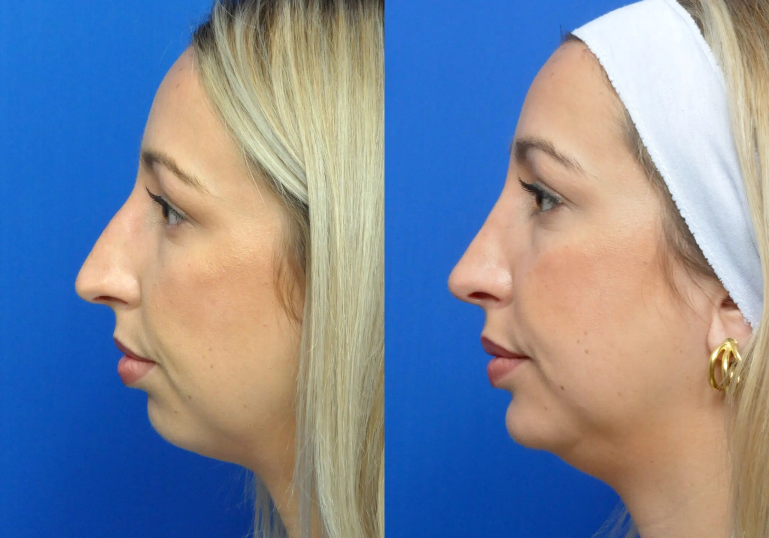 Facial Implant in Jacksonville, FL
