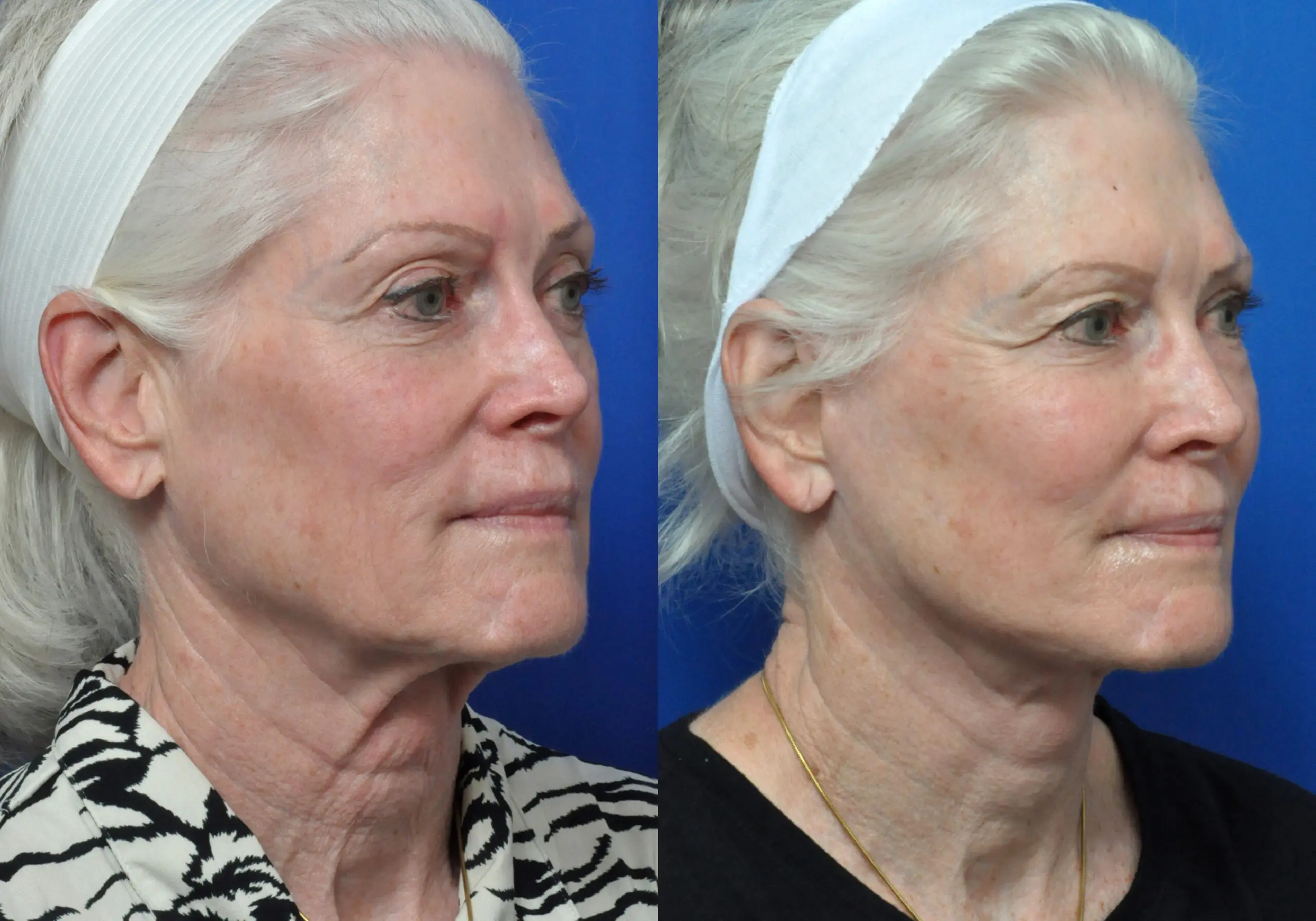 Fat Grafting in Jacksonville, FL