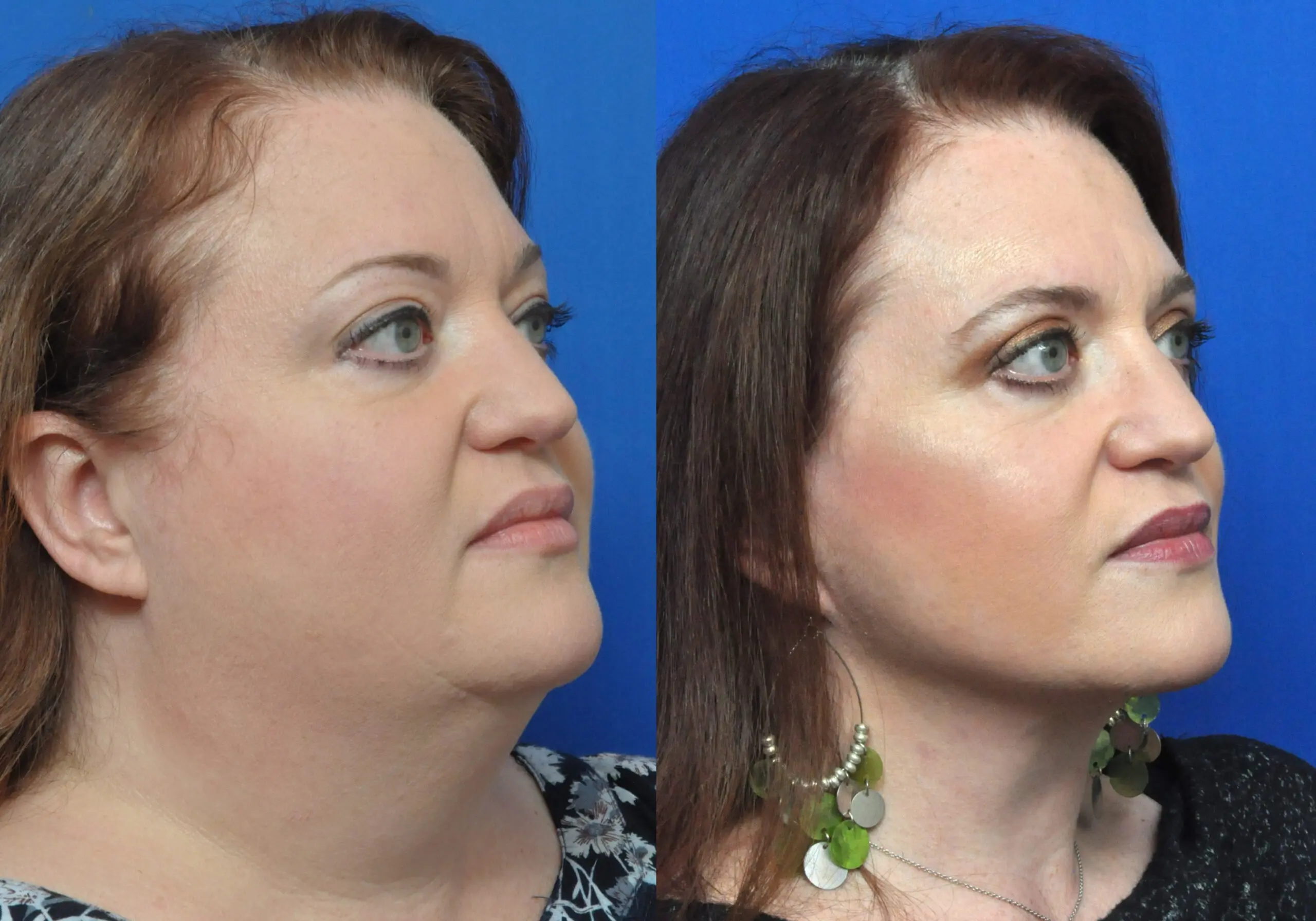 Facial Liposuction in Jacksonville, FL