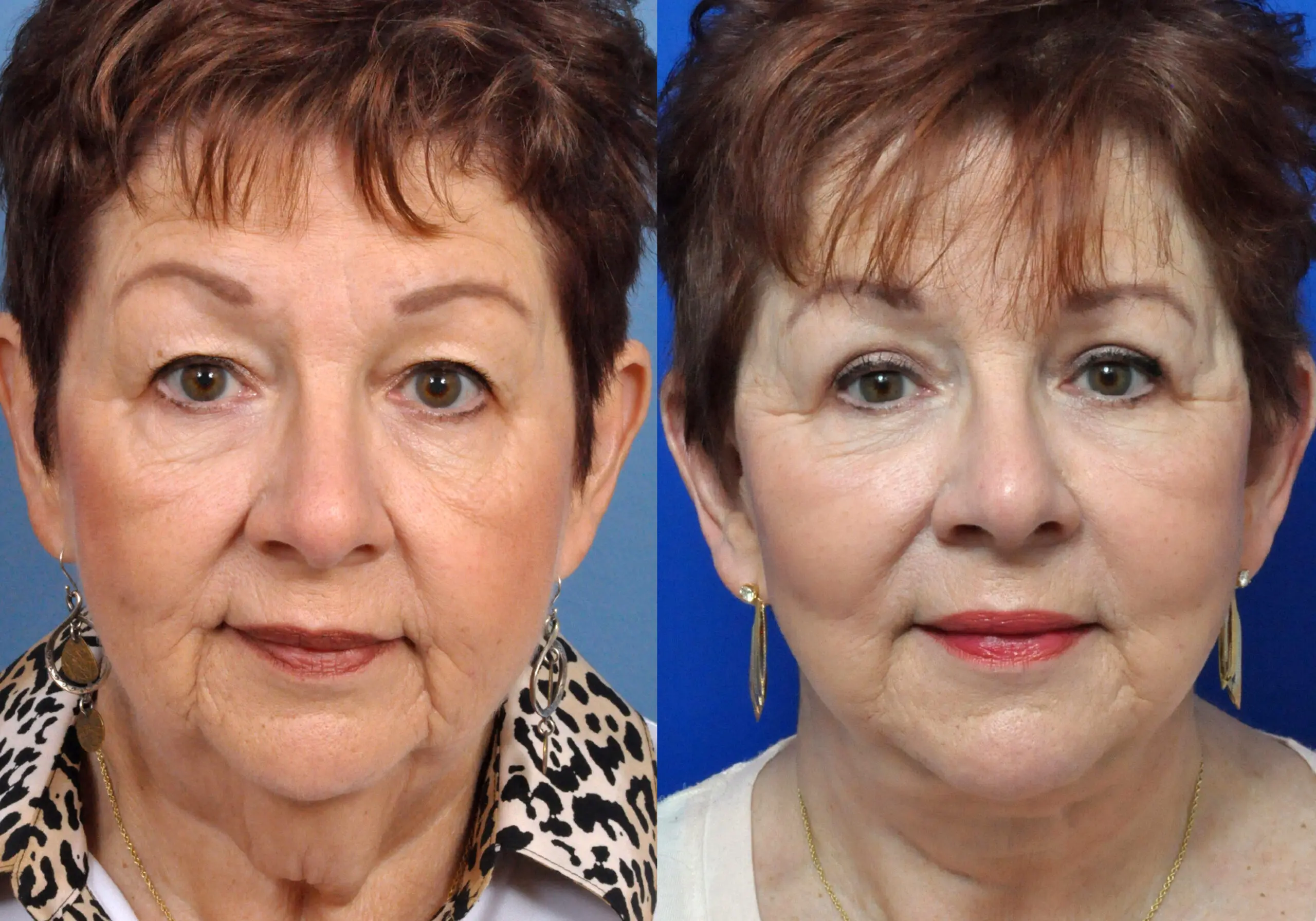 Fat Grafting in Jacksonville, FL