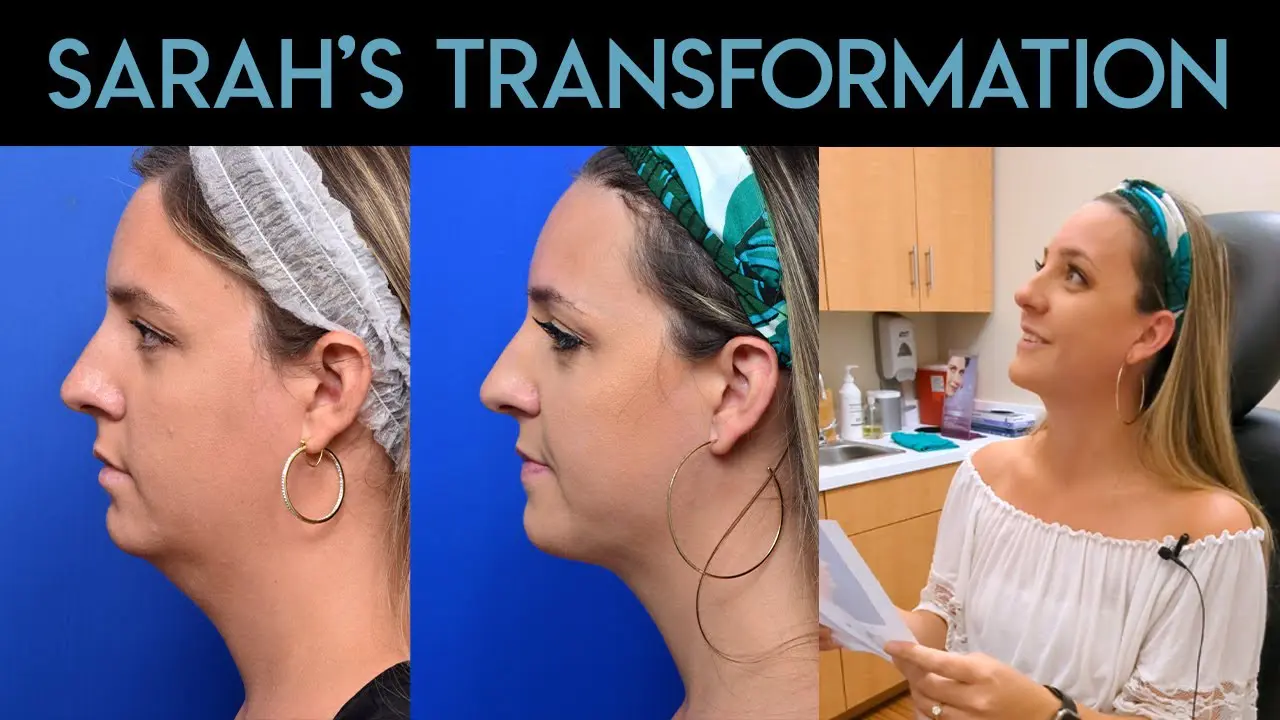 Facial Liposuction in Jacksonville, FL