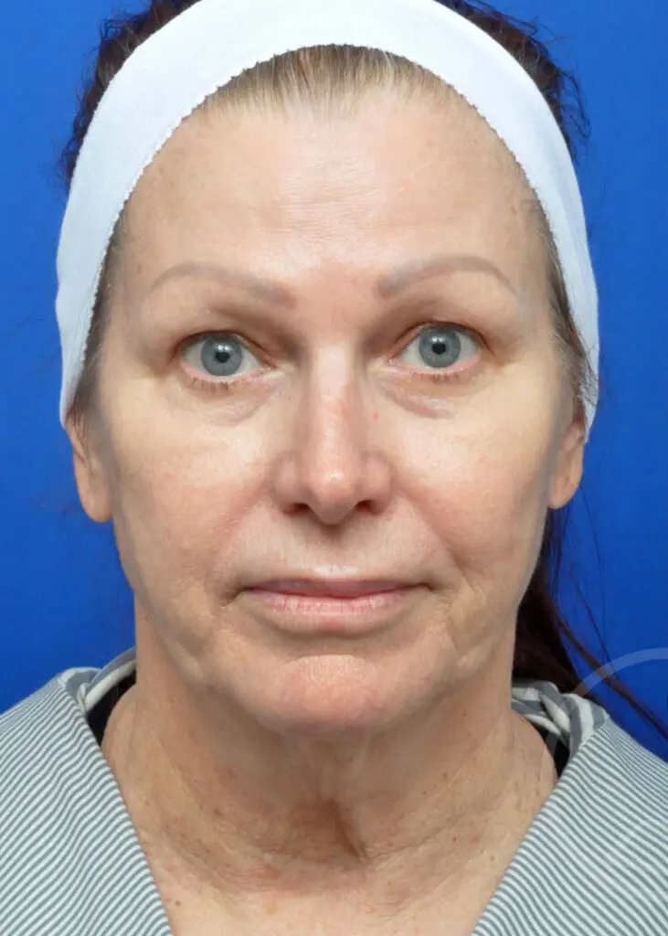 Plastic Surgery Before and After Pictures in Jacksonville, FL - Garcia Facial Plastic Surgery