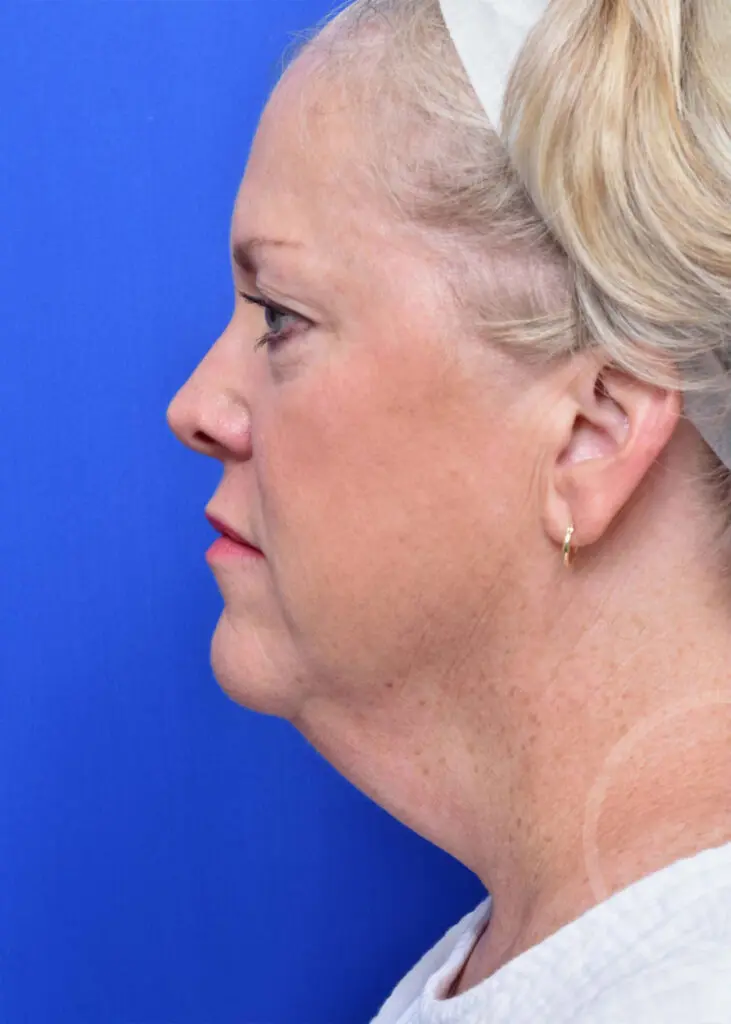Plastic Surgery Before and After Pictures in Jacksonville, FL - Garcia Facial Plastic Surgery