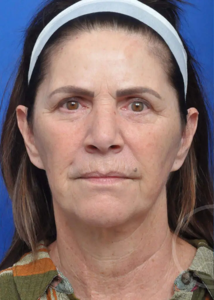 Plastic Surgery Before and After Pictures in Jacksonville, FL - Garcia Facial Plastic Surgery