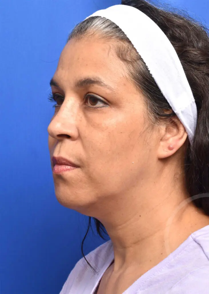 Plastic Surgery Before and After Pictures in Jacksonville, FL - Garcia Facial Plastic Surgery