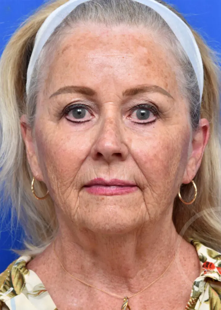 Plastic Surgery Before and After Pictures in Jacksonville, FL - Garcia Facial Plastic Surgery