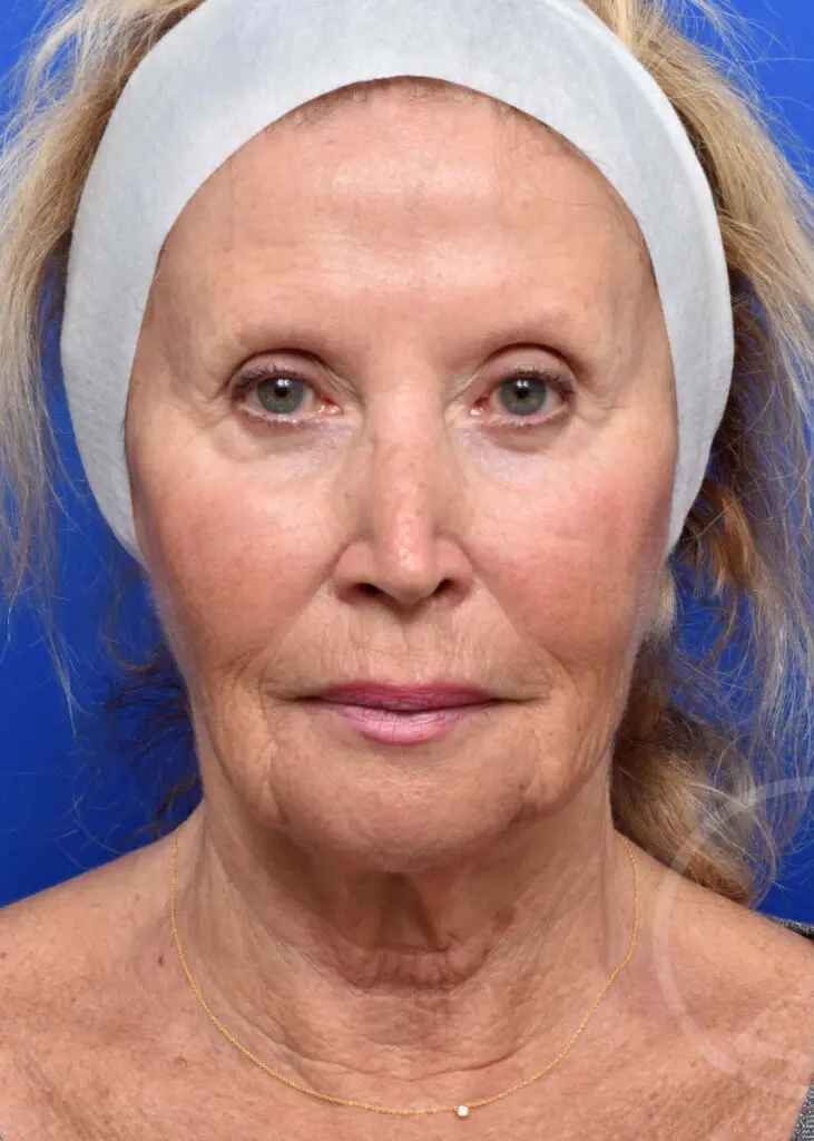 Plastic Surgery Before and After Pictures in Jacksonville, FL - Garcia Facial Plastic Surgery