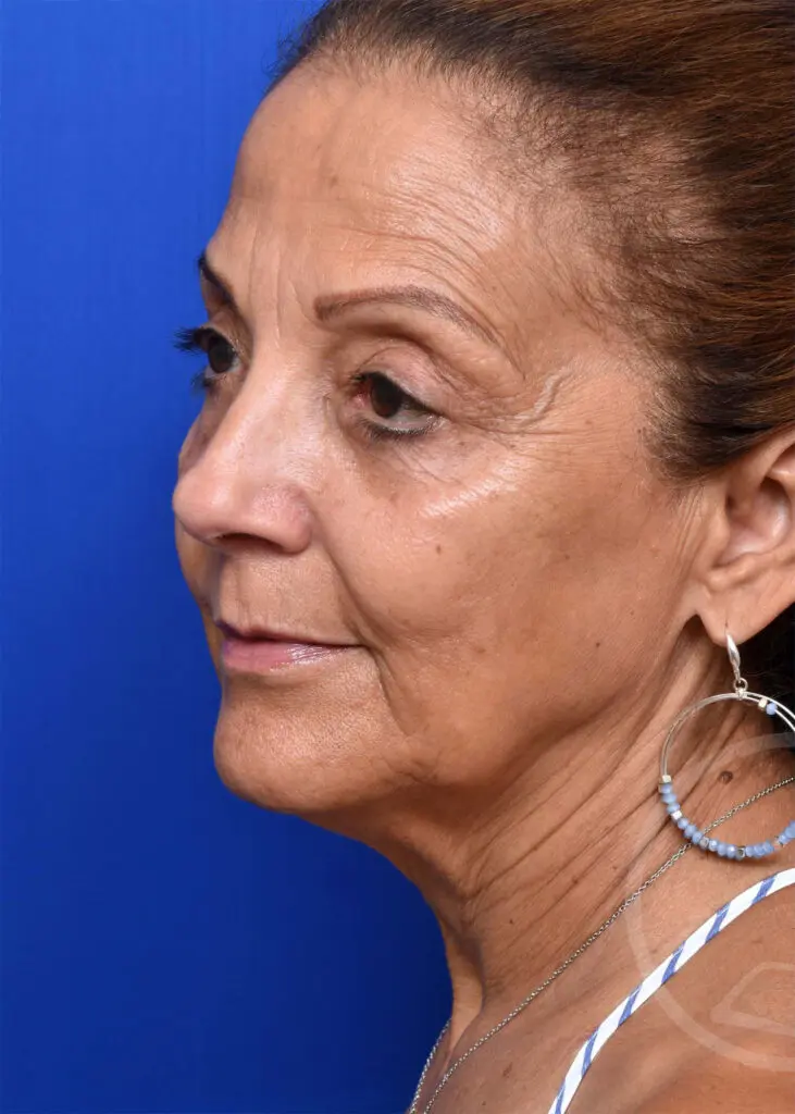 Plastic Surgery Before and After Pictures in Jacksonville, FL - Garcia Facial Plastic Surgery