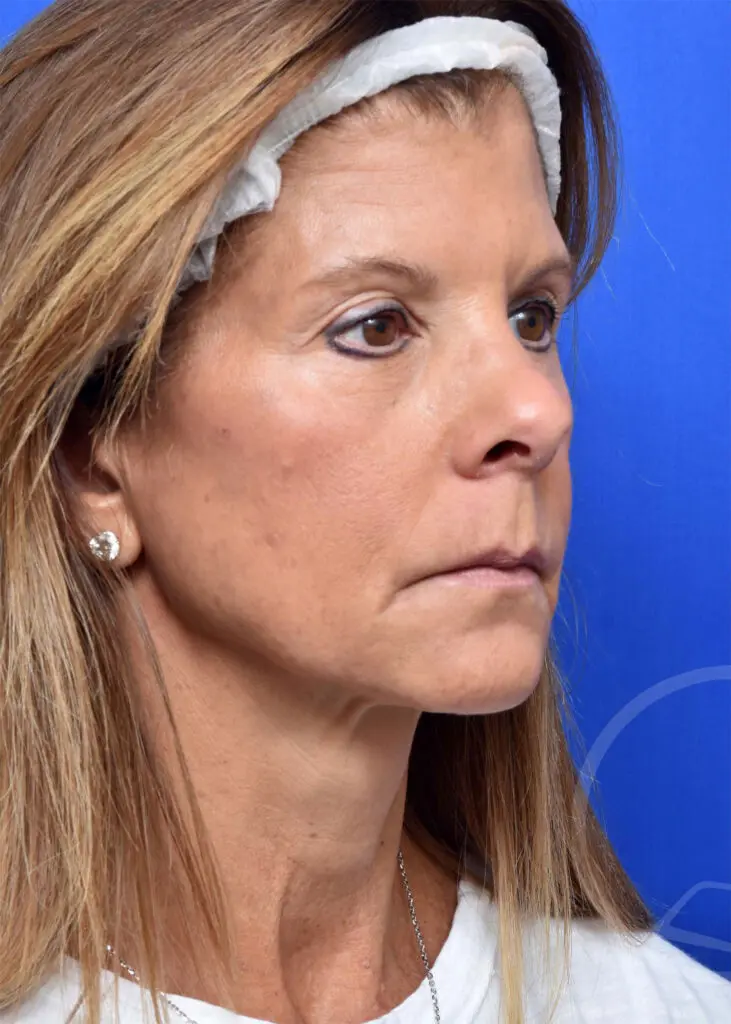 Plastic Surgery Before and After Pictures in Jacksonville, FL - Garcia Facial Plastic Surgery