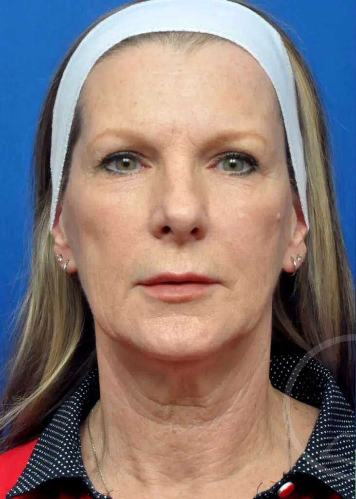 Plastic Surgery Before and After Pictures in Jacksonville, FL - Garcia Facial Plastic Surgery
