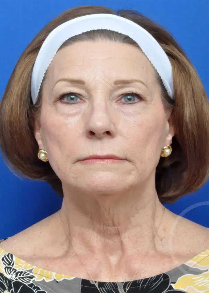 Plastic Surgery Before and After Pictures in Jacksonville, FL - Garcia Facial Plastic Surgery