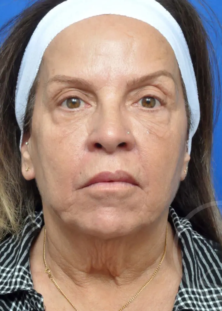 Plastic Surgery Before and After Pictures in Jacksonville, FL - Garcia Facial Plastic Surgery
