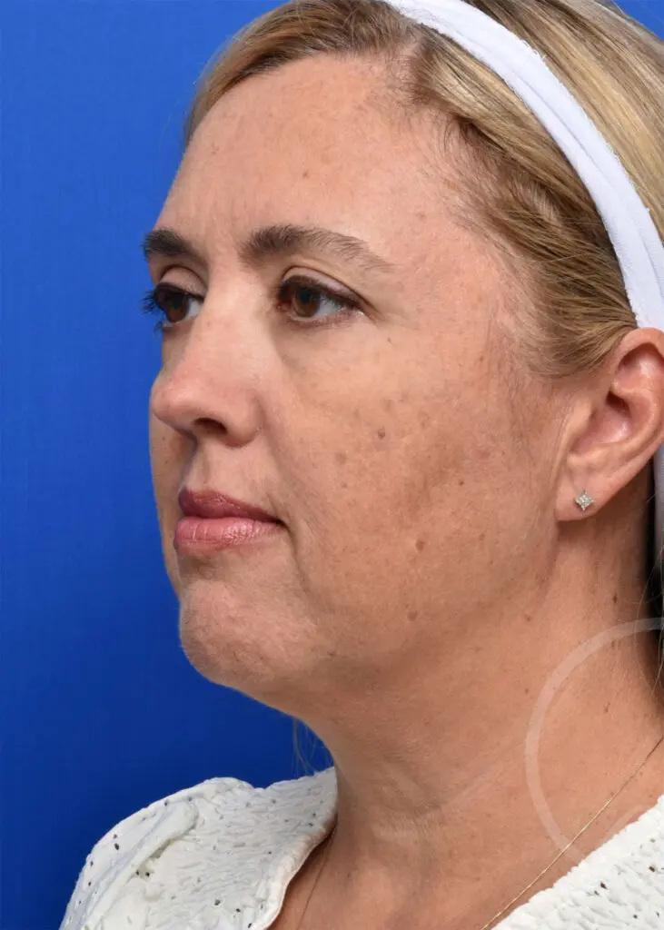 Plastic Surgery Before and After Pictures in Jacksonville, FL - Garcia Facial Plastic Surgery