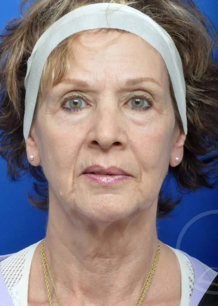 Plastic Surgery Before and After Pictures in Jacksonville, FL - Garcia Facial Plastic Surgery