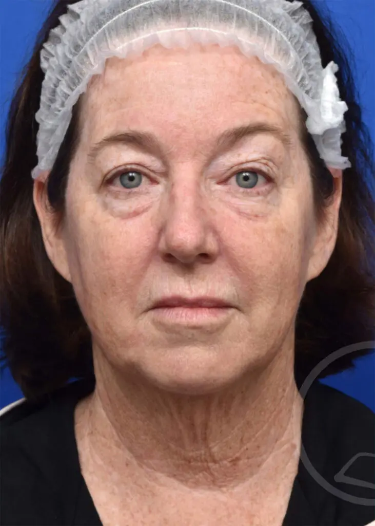 Plastic Surgery Before and After Pictures in Jacksonville, FL - Garcia Facial Plastic Surgery