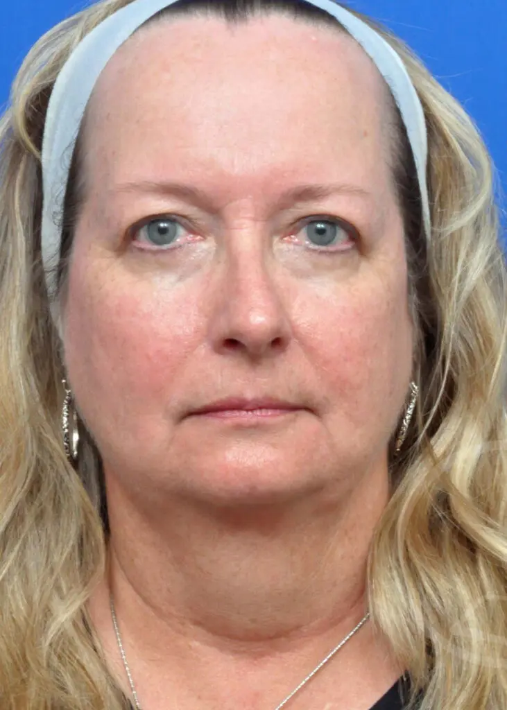 Plastic Surgery Before and After Pictures in Jacksonville, FL - Garcia Facial Plastic Surgery