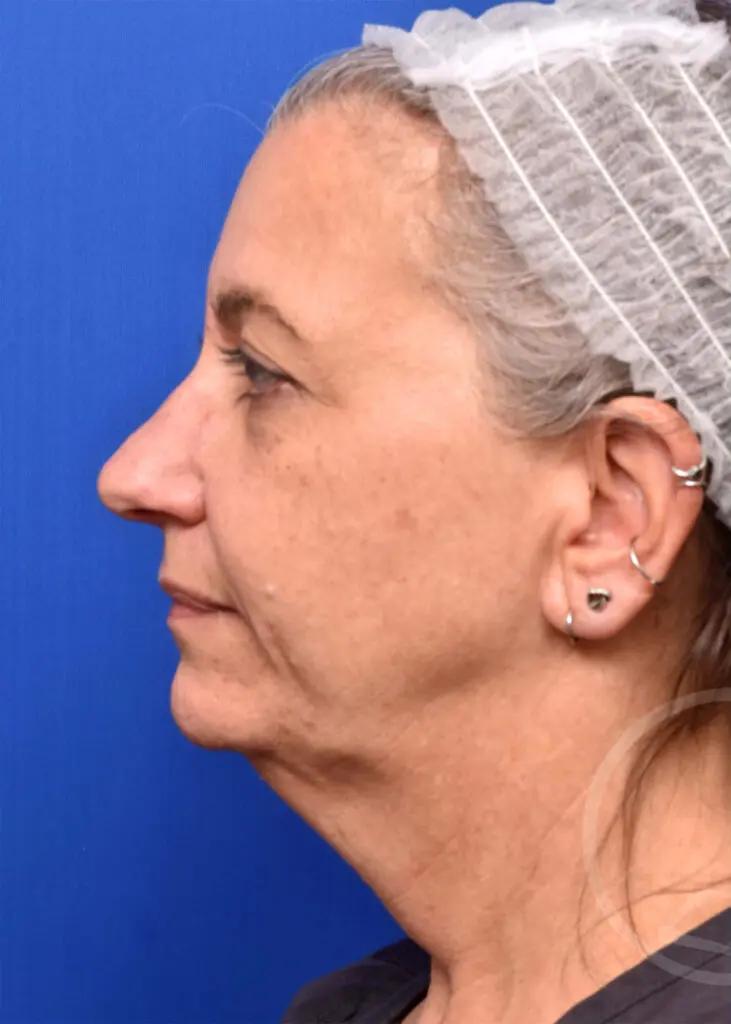Plastic Surgery Before and After Pictures in Jacksonville, FL - Garcia Facial Plastic Surgery