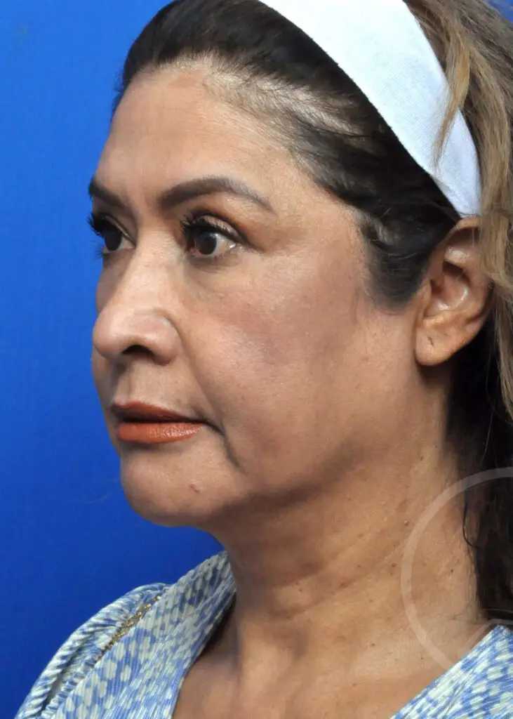 Plastic Surgery Before and After Pictures in Jacksonville, FL - Garcia Facial Plastic Surgery