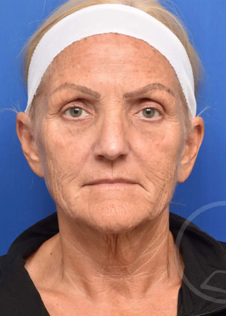 Plastic Surgery Before and After Pictures in Jacksonville, FL - Garcia Facial Plastic Surgery