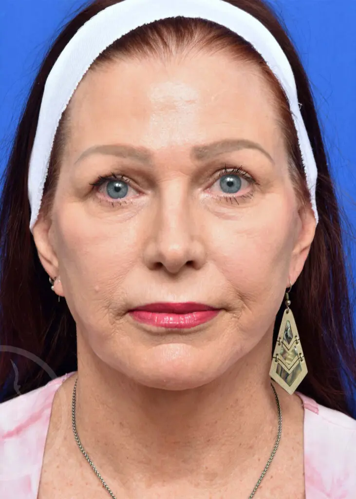 Plastic Surgery Before and After Pictures in Jacksonville, FL - Garcia Facial Plastic Surgery