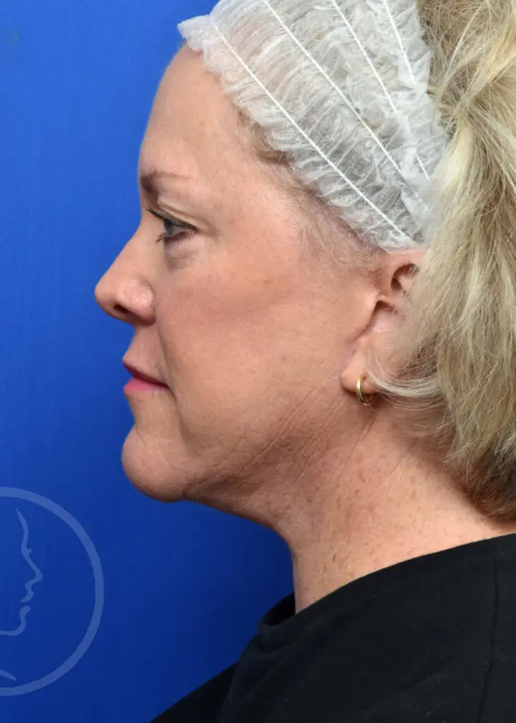 Plastic Surgery Before and After Pictures in Jacksonville, FL - Garcia Facial Plastic Surgery