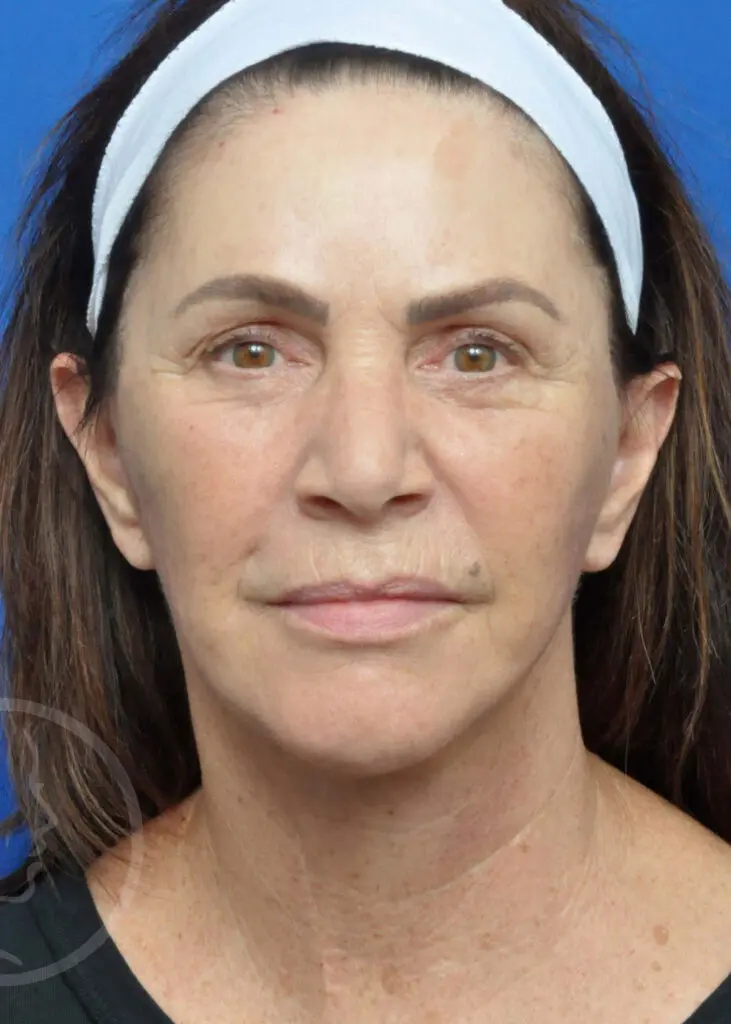 Plastic Surgery Before and After Pictures in Jacksonville, FL - Garcia Facial Plastic Surgery