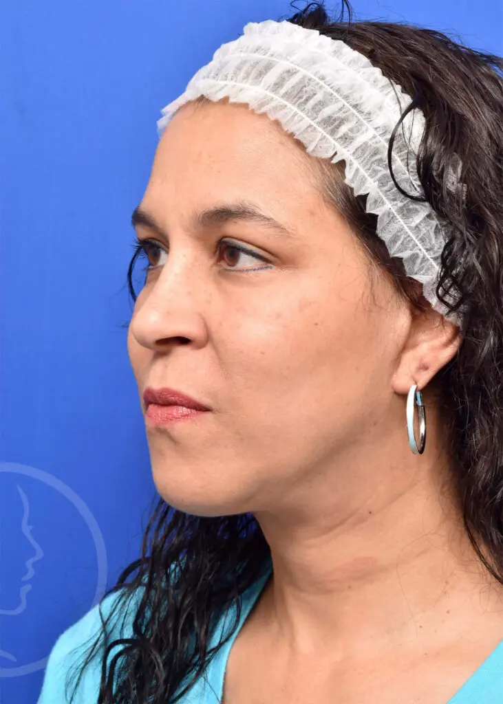 Plastic Surgery Before and After Pictures in Jacksonville, FL - Garcia Facial Plastic Surgery