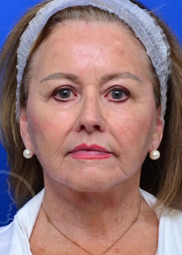Plastic Surgery Before and After Pictures in Jacksonville, FL - Garcia Facial Plastic Surgery