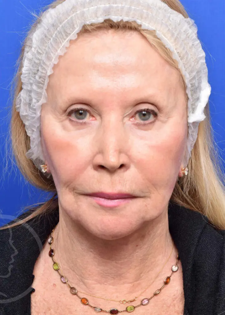 Plastic Surgery Before and After Pictures in Jacksonville, FL - Garcia Facial Plastic Surgery