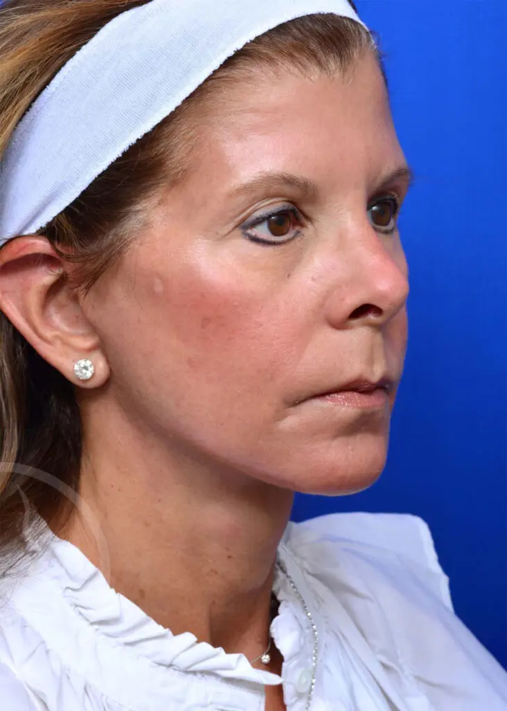 Plastic Surgery Before and After Pictures in Jacksonville, FL - Garcia Facial Plastic Surgery