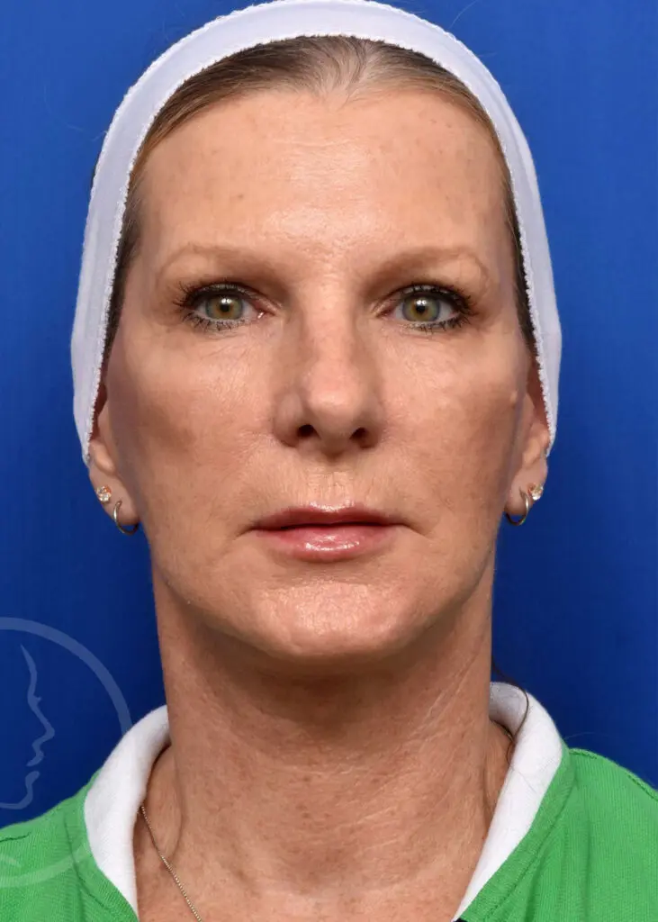 Plastic Surgery Before and After Pictures in Jacksonville, FL - Garcia Facial Plastic Surgery