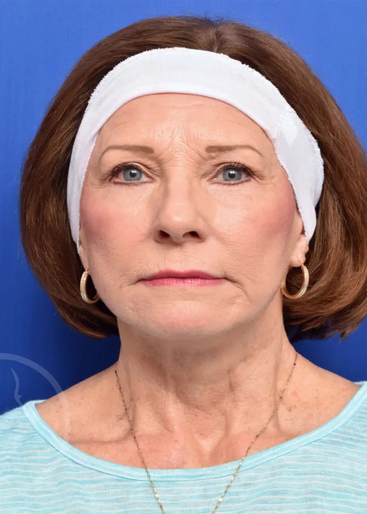 Plastic Surgery Before and After Pictures in Jacksonville, FL - Garcia Facial Plastic Surgery