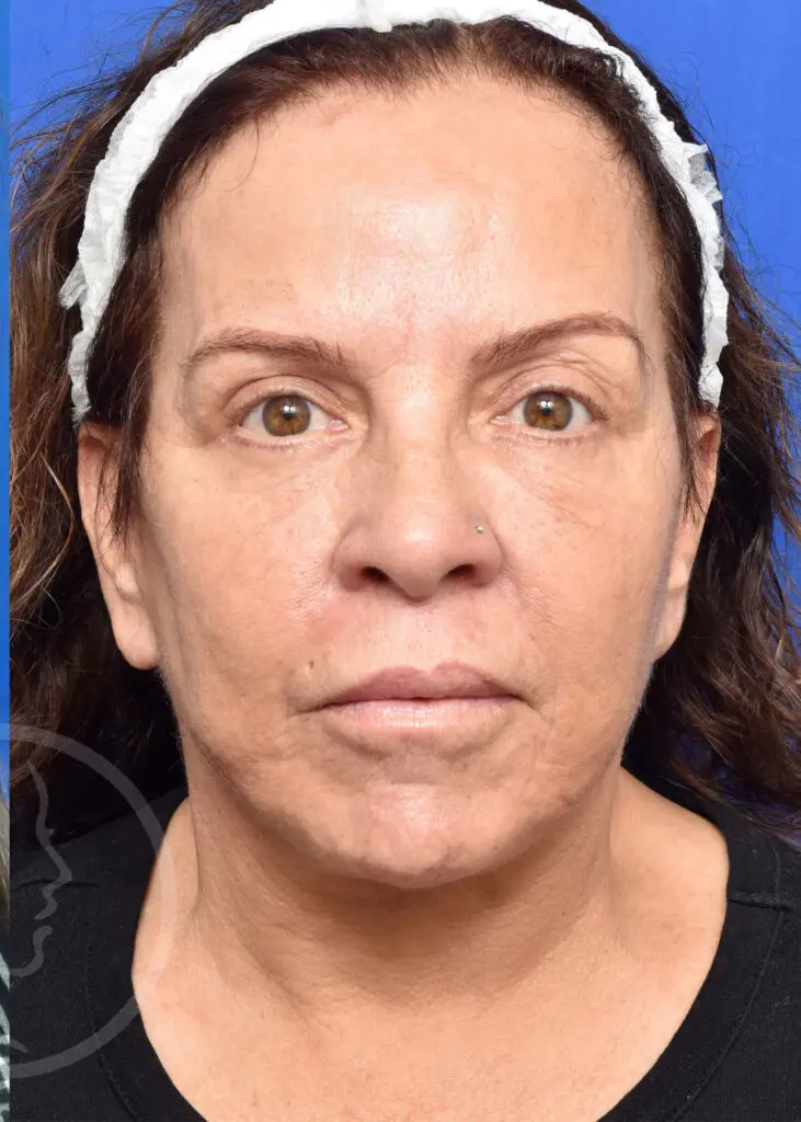 Plastic Surgery Before and After Pictures in Jacksonville, FL - Garcia Facial Plastic Surgery