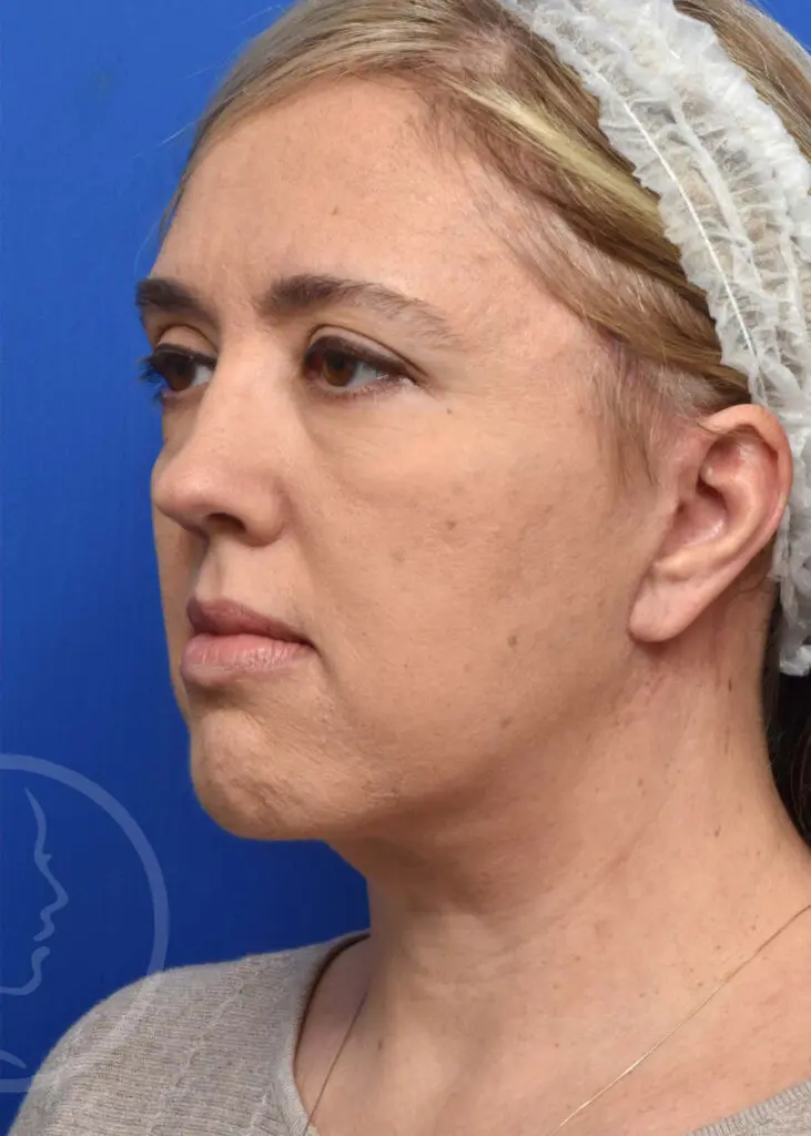Plastic Surgery Before and After Pictures in Jacksonville, FL - Garcia Facial Plastic Surgery