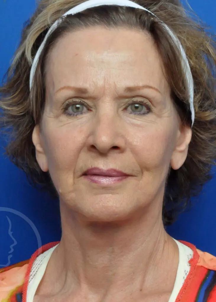 Plastic Surgery Before and After Pictures in Jacksonville, FL - Garcia Facial Plastic Surgery