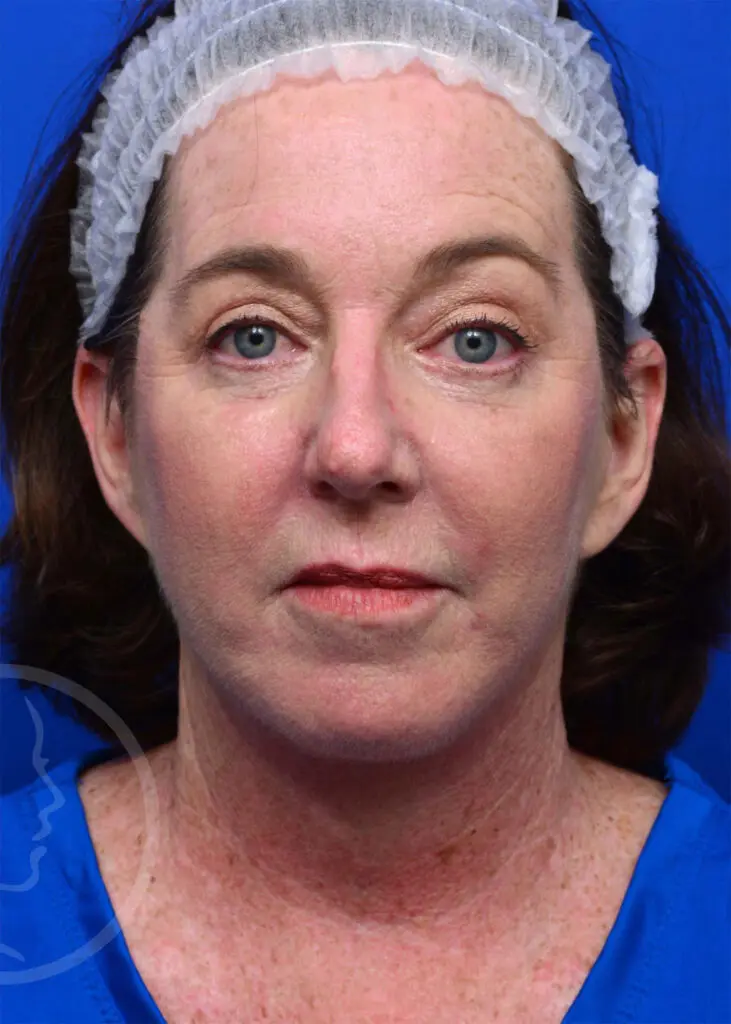 Plastic Surgery Before and After Pictures in Jacksonville, FL - Garcia Facial Plastic Surgery