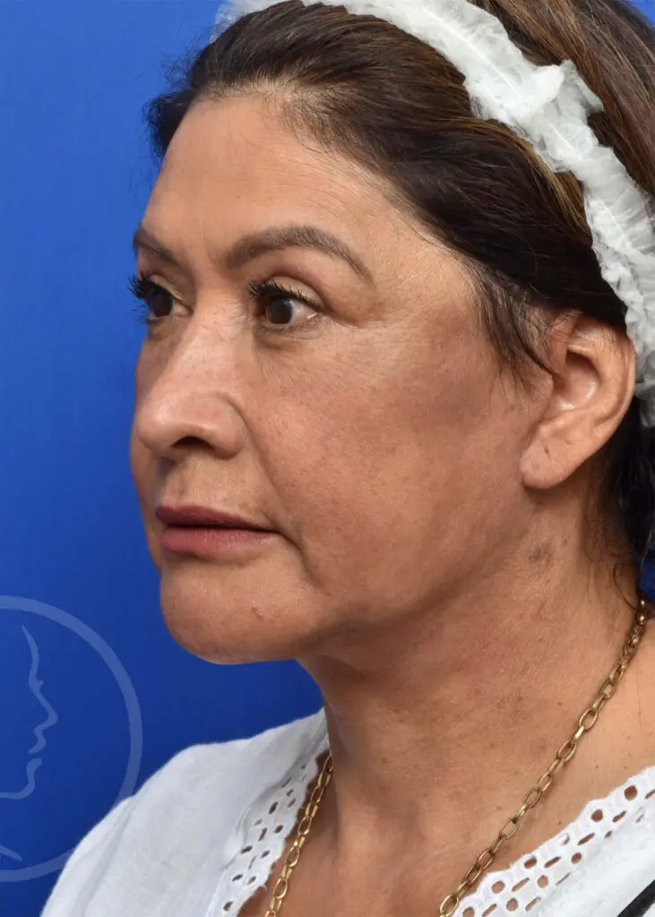 Plastic Surgery Before and After Pictures in Jacksonville, FL - Garcia Facial Plastic Surgery