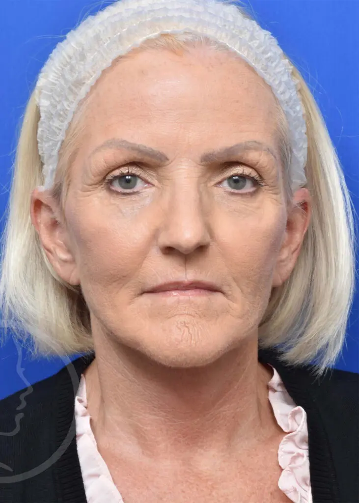 Plastic Surgery Before and After Pictures in Jacksonville, FL - Garcia Facial Plastic Surgery