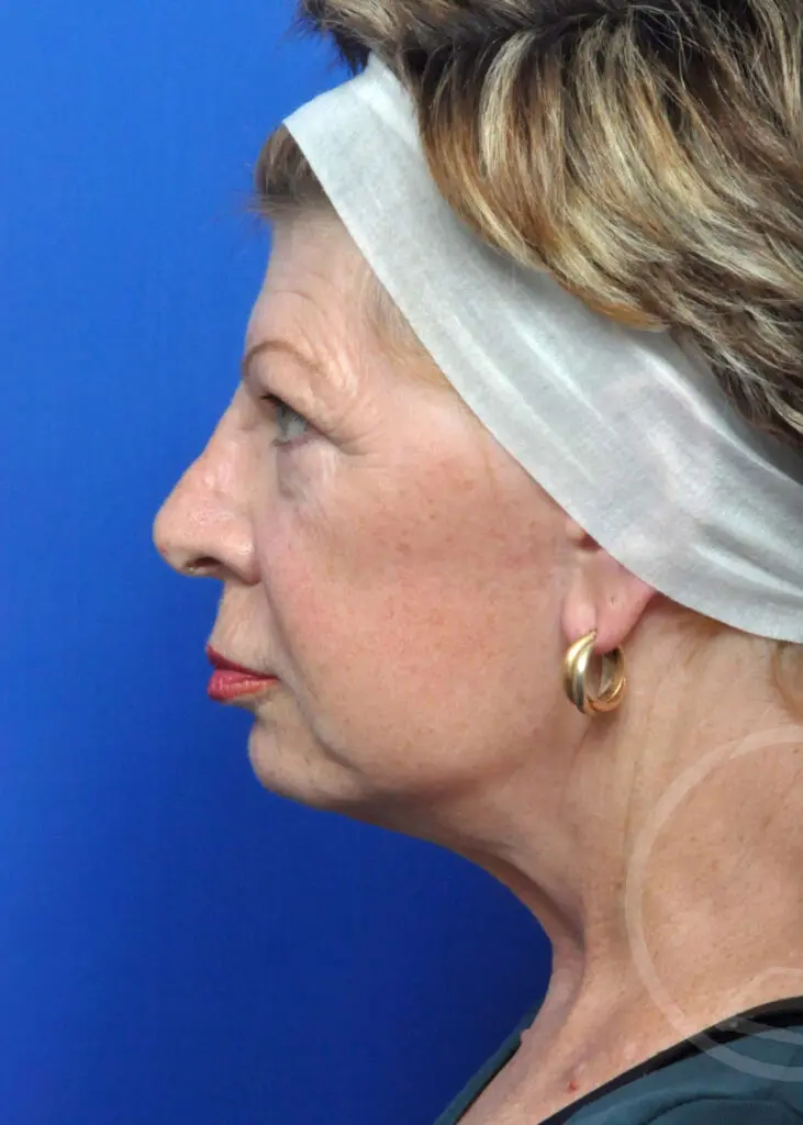 Plastic Surgery Before and After Pictures in Jacksonville, FL - Garcia Facial Plastic Surgery