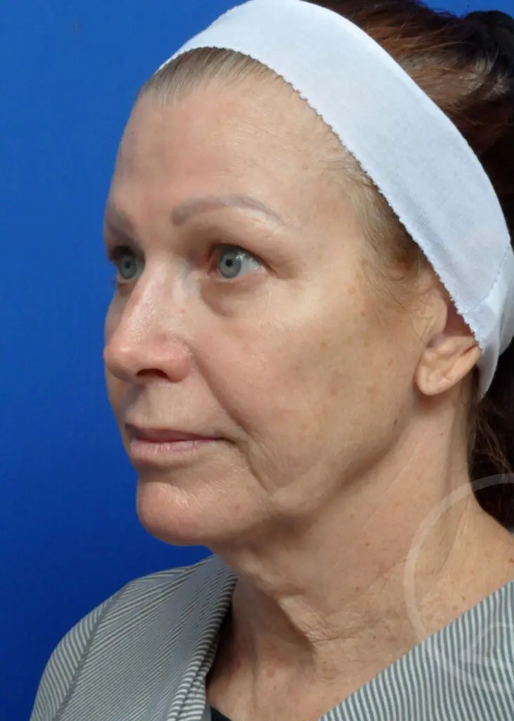 Plastic Surgery Before and After Pictures in Jacksonville, FL - Garcia Facial Plastic Surgery