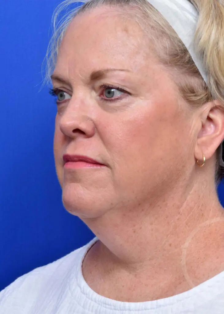 Plastic Surgery Before and After Pictures in Jacksonville, FL - Garcia Facial Plastic Surgery