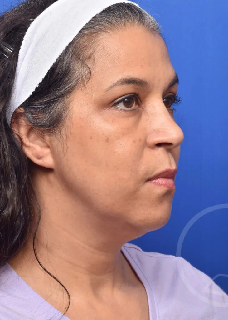 Plastic Surgery Before and After Pictures in Jacksonville, FL - Garcia Facial Plastic Surgery
